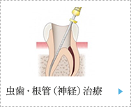 虫歯・根管(神経)治療
