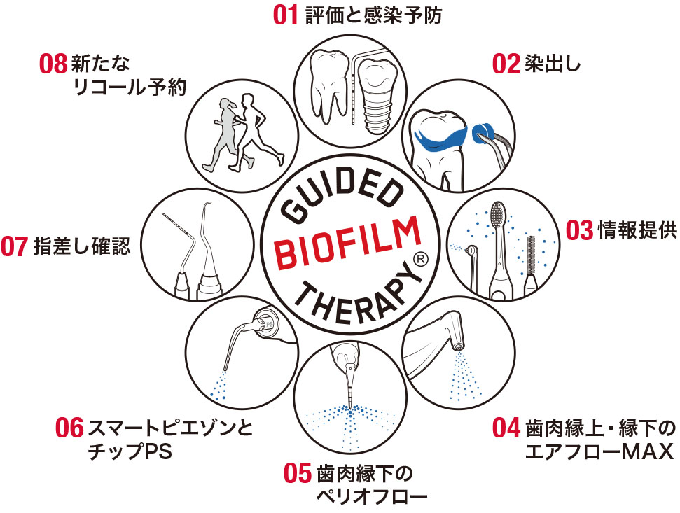 文京区(茗荷谷・護国寺)の歯医者、小日向台町歯科のEMSエアフロー/GBT(Guided Biofilm Therapy)