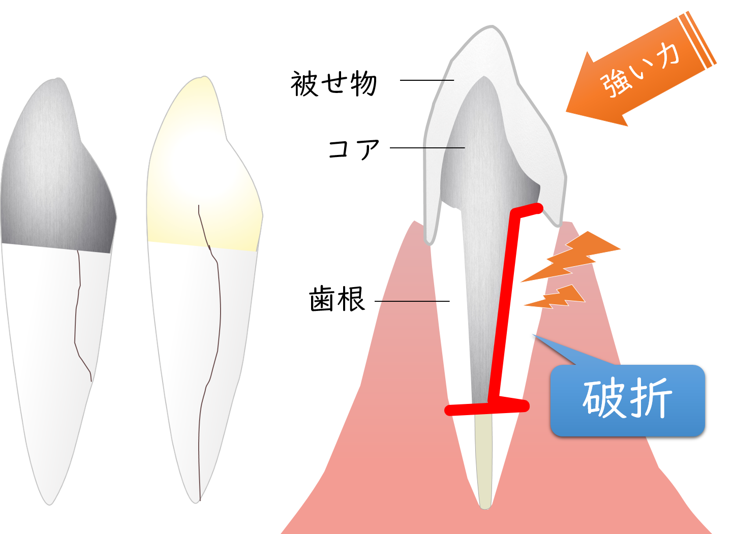 文京区（茗荷谷・護国寺）の歯医者、小日向台町歯科の歯根破折の治療