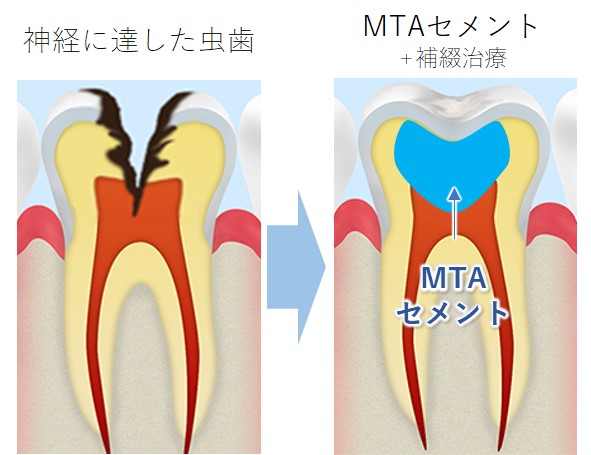 文京区（茗荷谷・護国寺）の歯医者、小日向台町歯科のMTAセメント